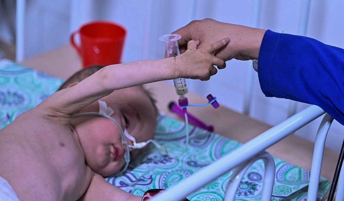 Un millón de niños en Colombia en riesgo de desnutriciónUn millón de niños en Colombia en riesgo de desnutrición