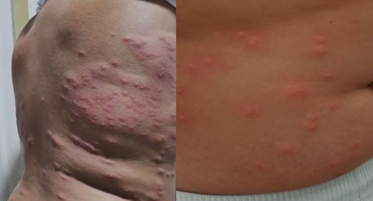 Autoridades de Santa Marta descartan contaminación del mar como causa de brotes en la piel reportados por bañistas