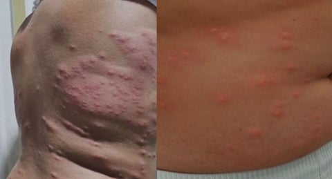 Autoridades de Santa Marta descartan contaminación del mar como causa de brotes en la piel reportados por bañistas