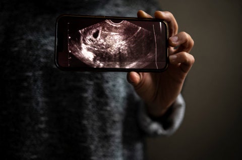 Una mujer sostiene en su teléfono la fotografía de un ecograma que muestra su embarazo.