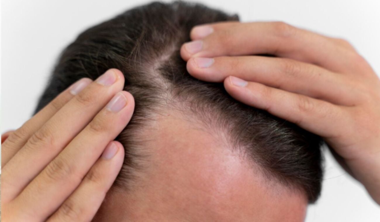 Caída del pelo en hombres