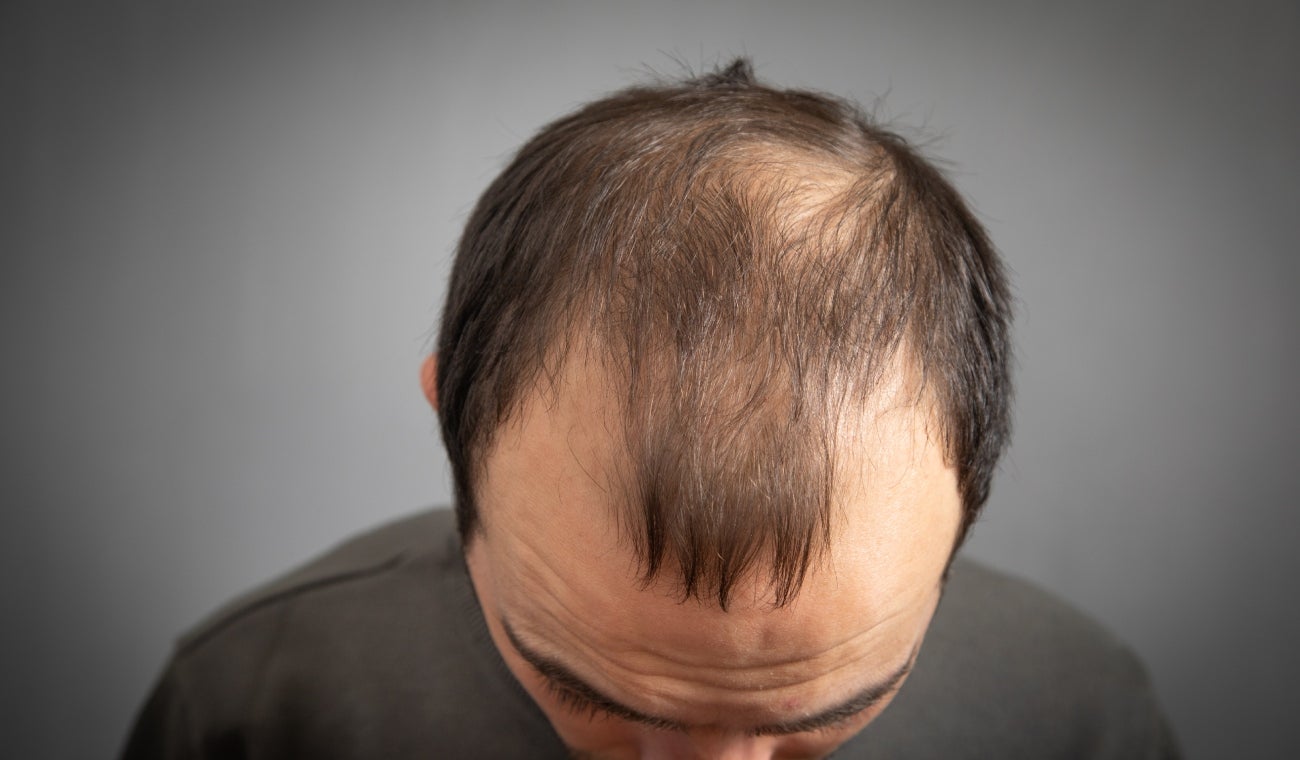 Alopecia