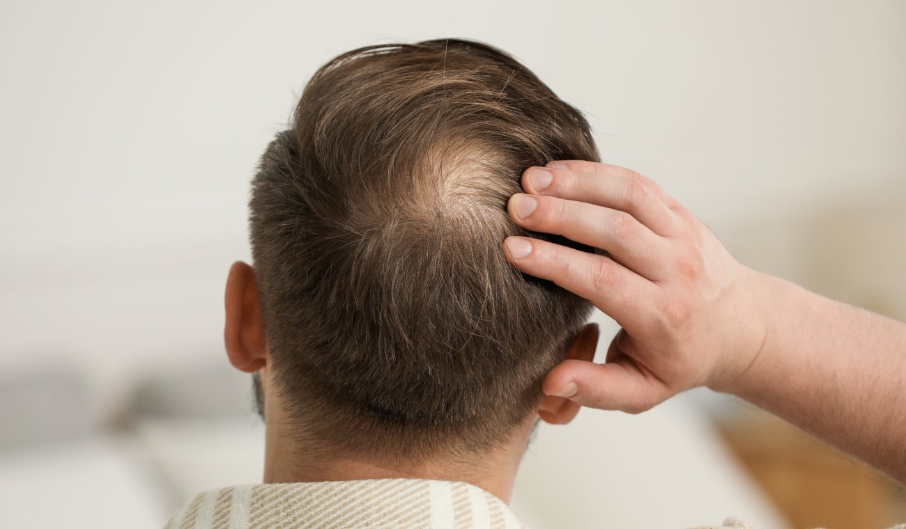 Los FACTORES SILENCIOSOS que ACELERAN la CALVICIE: como prevenirlos