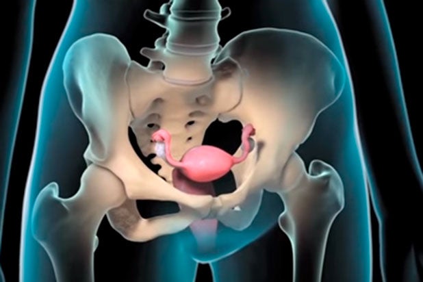 Endometriosis.jpg