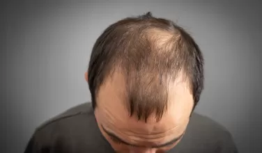 Alopecia