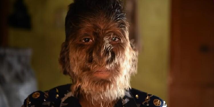 La hipertricosis es una enfermedad conocida como el "síndrome del hombre lobo".