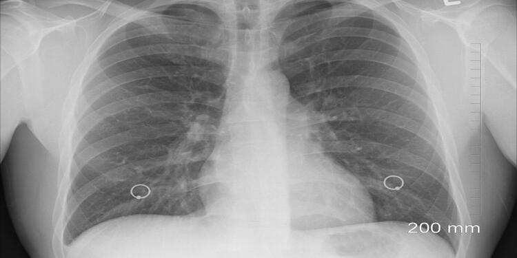 Cáncer de pulmón Cáncer de pulmón