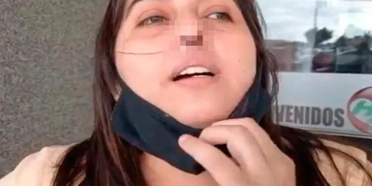 Mujer argentina que perdió el cartílago de su nariz