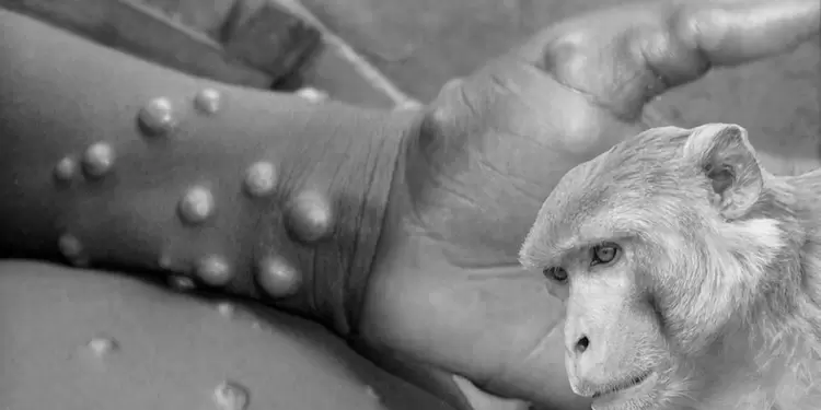 Viruela del mono, virus que proviene de un simio Viruela del mono