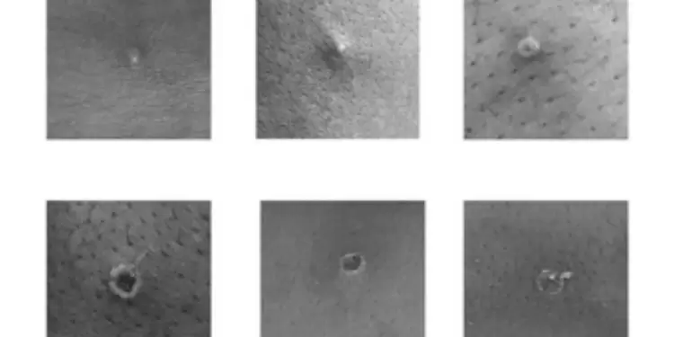 Infectados por Viruela del mono