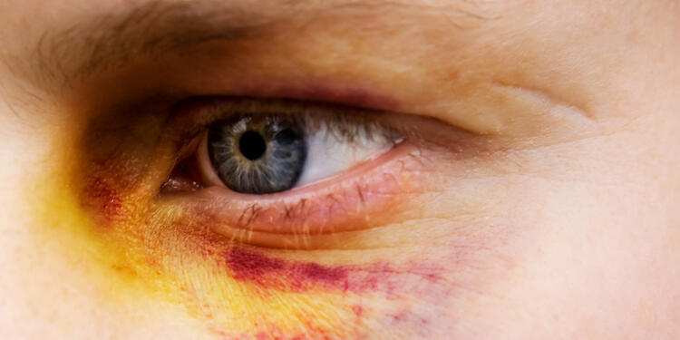 Ojo-morado-Ingimage.jpg