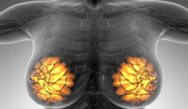 Imagen alusiva al cáncer de mamá