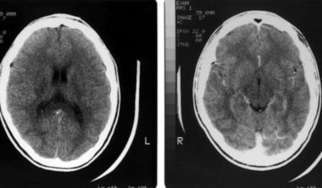 Cerebro