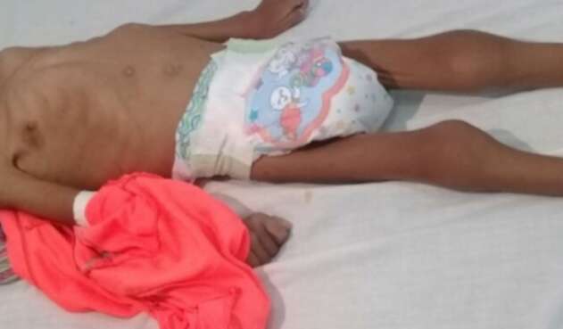Niño indígena sufre desnutrición en Juradó, Chocó