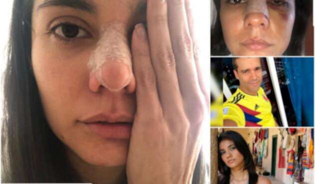 Eileen Moreno y las secuelas de la golpiza propinada por Alejandro García Eileen Moreno y las secuelas de la golpiza propinada por Alejandro García