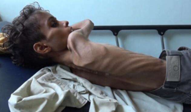 Niños hambre Yemen