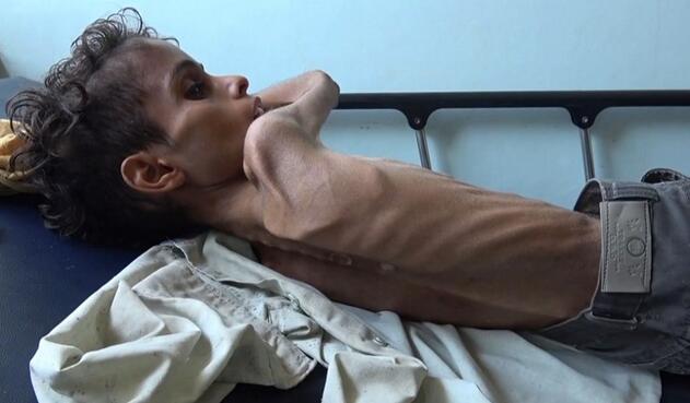 Niños hambre Yemen