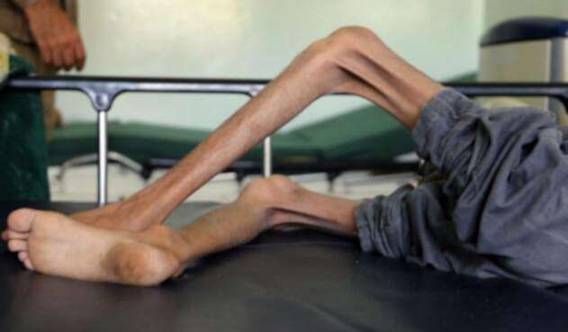 Niños desnutridos en Yemen Niños desnutridos en Yemen