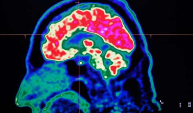 El cerebro utiliza el azúcar como combustible.