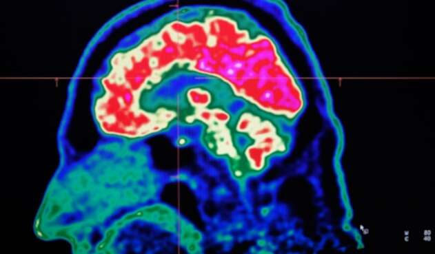Implante cerebral