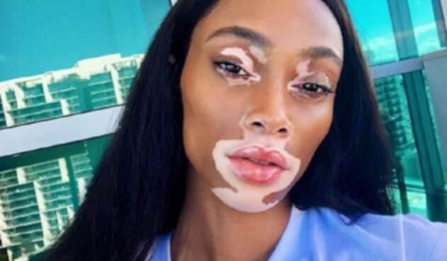 Winnie Harlow