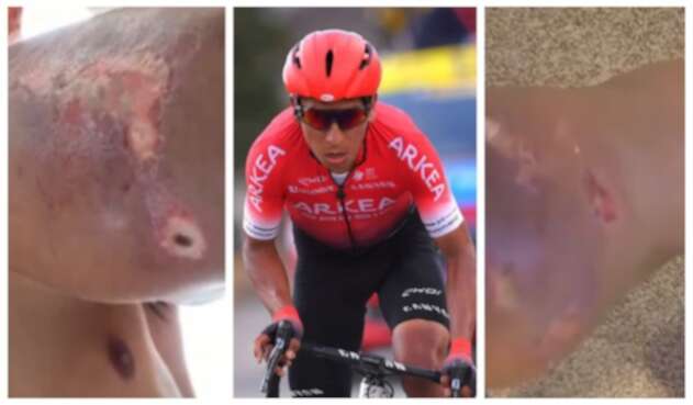Heridas de Nairo Quintana