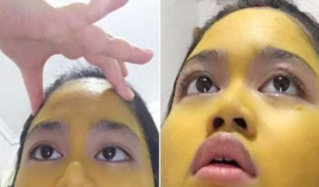Joven se aplicó mascarilla de curcumá pero no le fue como esperaba