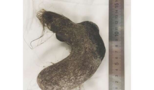 La bola de pelos hallada en estómago de una niña