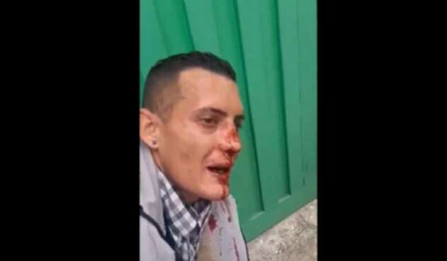 Le rompieron la nariz a ladrón de Fontibón Le rompieron la nariz a ladrón de Fontibón