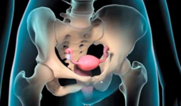 Endometriosis.jpg