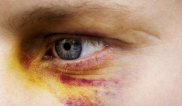 Ojo-morado-Ingimage-2.jpg