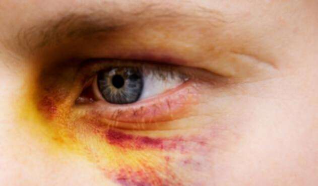 Ojo-morado-Ingimage.jpg