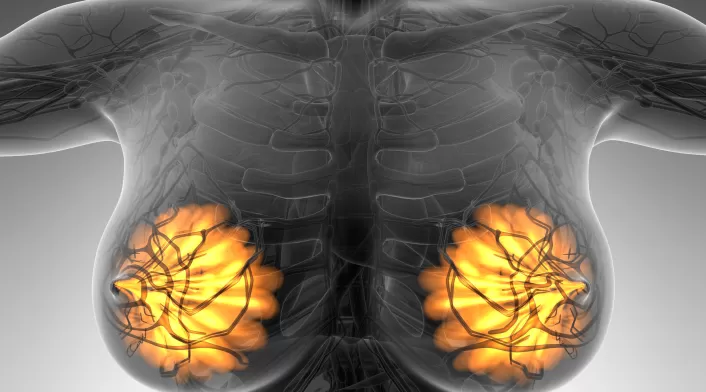 Cáncer de mamá