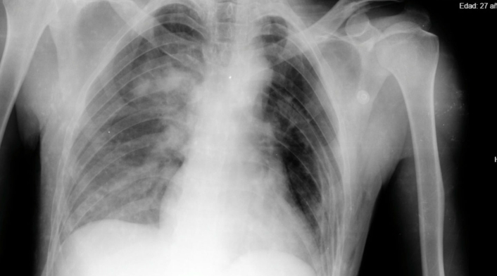 El paciente ingresó a un centro asistencial inconsciente y con 98 % de probabilidades de morir.