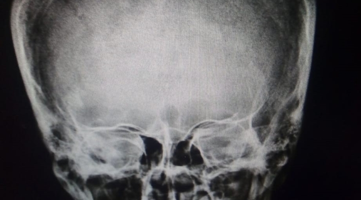 Radiografía del caso de un hombre apuñalado en la cabeza