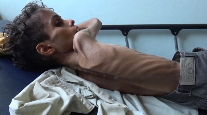 Niños hambre Yemen