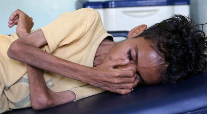 Niños desnutridos en Yemen Niños desnutridos en Yemen