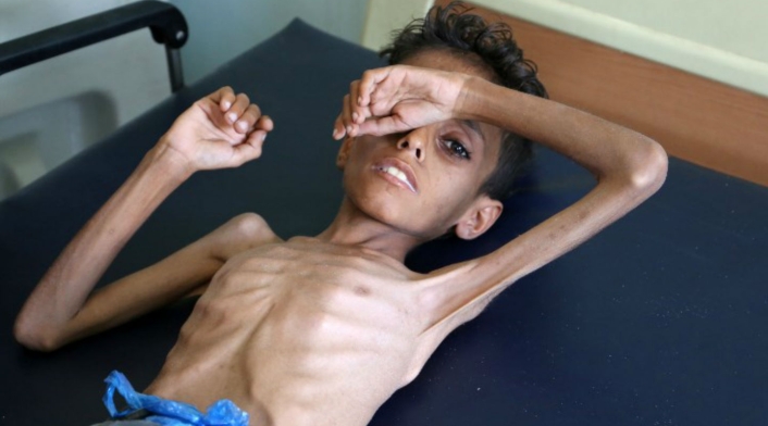 Niños desnutridos en Yemen Niños desnutridos en Yemen
