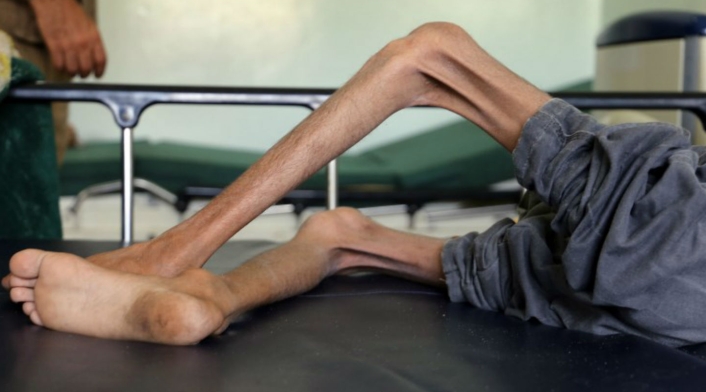 Niños desnutridos en Yemen Niños desnutridos en Yemen