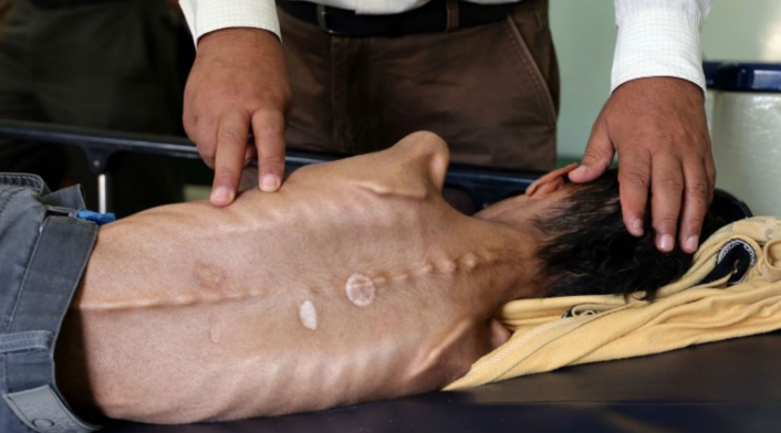Niños desnutridos en Yemen Niños desnutridos en Yemen