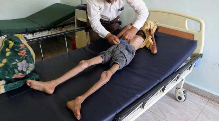 Niños desnutridos en Yemen Niños desnutridos en Yemen