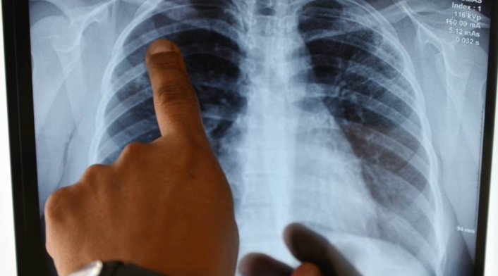 Los científicos han hecho grandes descubrimientos sobre lo que hace el coronavirus en los pulmones.