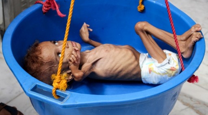 Bassem Mohamed Hassan, un niño yemení de dos años que sufre de desnutrición, fue medido en un hospital en el distrito norte de Abs en la provincia noroeste de Hajjah el 19 de septiembre de 2018.