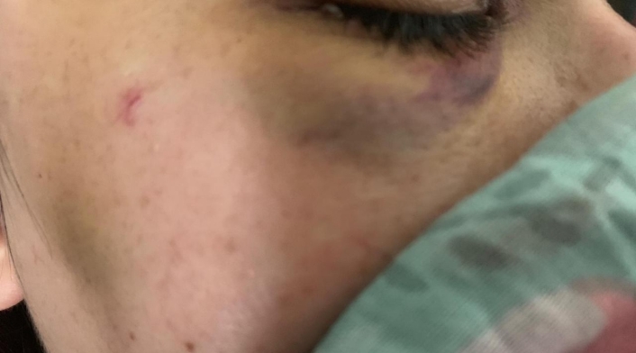 Una de las mujeres tiene tres fracturas al lado del ojo.
