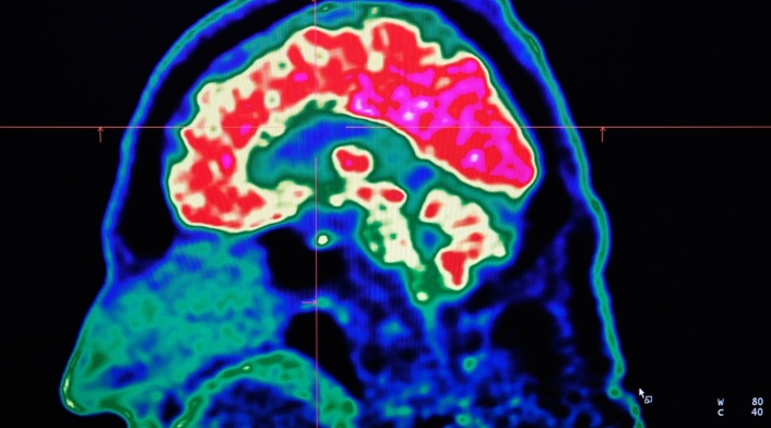 Implante cerebral