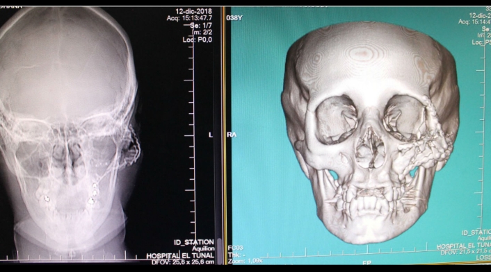 Reconstrucción de un rostro tras ser impactado por una bala