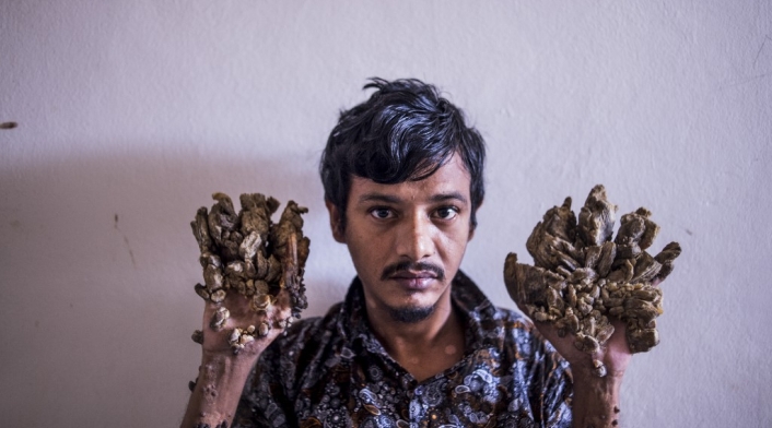 AFP Abul Bajandar, hombre árbol
