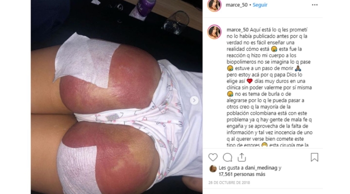 La DJ Marcela Reyes así contó su tragedia con los biopolímeros.
