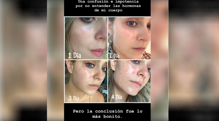 Rostro de Laura Tobón afectada