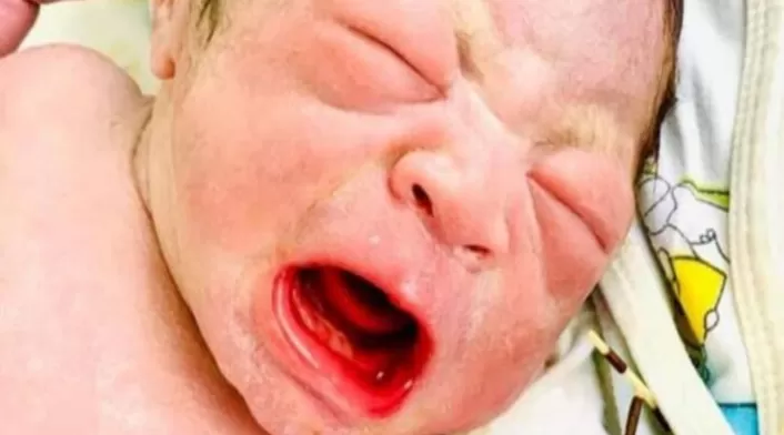 Bebé nació con el dispositivo anticonceptivo de la mamá en la mano